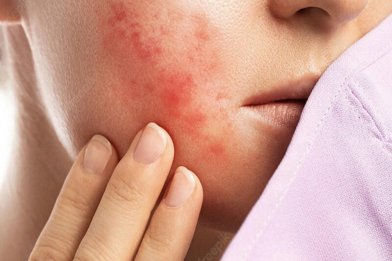 Atasi Jerawat di Usia Muda dengan Kandungan Skincare yang Efektif dan Aman Digunakan