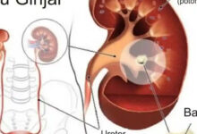 7 Penyebab Batu Ginjal pada Perempuan yang Sering Tak Disadari