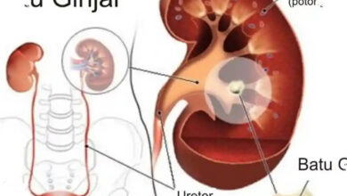 7 Penyebab Batu Ginjal pada Perempuan yang Sering Tak Disadari