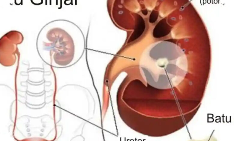 7 Penyebab Batu Ginjal pada Perempuan yang Sering Tak Disadari