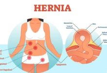 Hernia pada Anak Tak Bisa Sembuh Sendiri, Benjolan Kecil Ini Perlu Diwaspadai