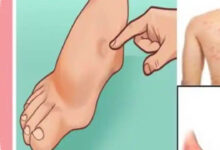 7 Kebiasaan yang Diam-diam Bisa Merusak Ginjal, Bukan Hanya Diabetes dan Tekanan Darah Tinggi