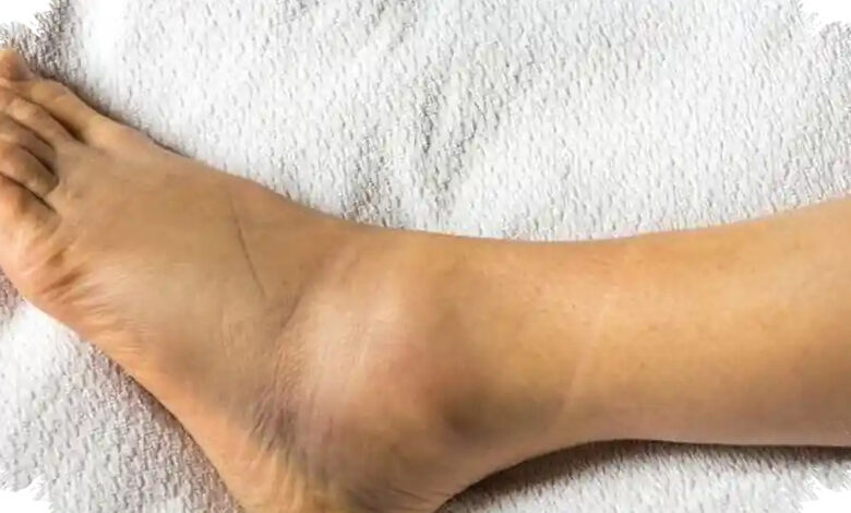 8 Tanda Tubuh Kelebihan Garam, dari Kaki Bengkak hingga Jantung Berdebar