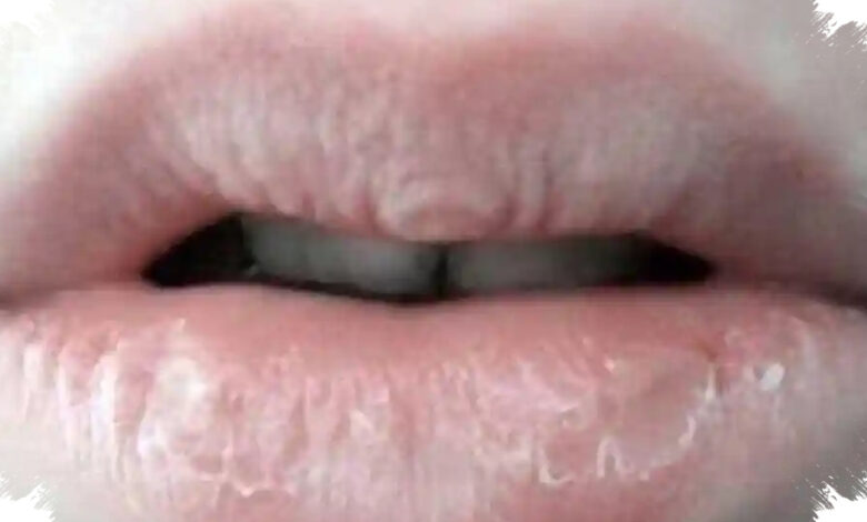 5 Kebiasaan Sederhana agar Bibir Tidak Makin Kering dan Pecah-Pecah