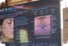 Melasma Sering Kambuh di Kulit Tropis, Ini Alasan dan Cara Mengendalikannya