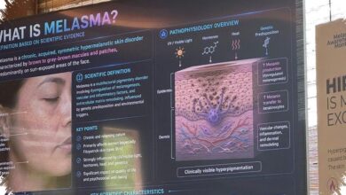 Melasma Sering Kambuh di Kulit Tropis, Ini Alasan dan Cara Mengendalikannya