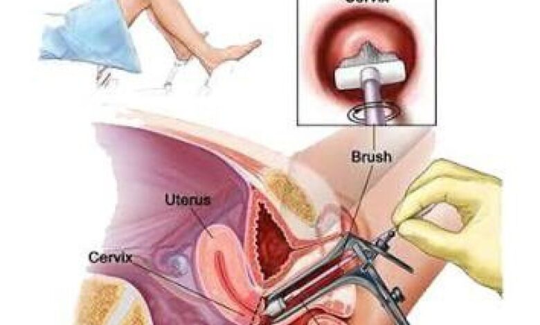 Gaya Hidup Kota Menggeser Ancaman Kanker Perempuan, Payudara dan Rahim Mendominasi