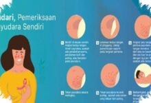 Terapi Presisi Buka Harapan Hidup Lebih Panjang bagi Pasien Kanker Perempuan